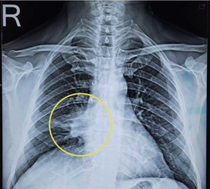 પાન – ફાકીના વ્યસનીઓ સાવધાન: રાજકોટના ડો.યજ્ઞેશ પુરોહિતે દર્દીના ફેફસામાં ૯ મહિનાથી ફસાયેલો સોપારીનો ટુકડો કાઢી જીવ બચાવ્યો