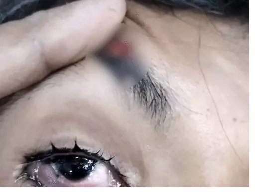 બે છાત્રોના ઝઘડામાં સમાધાન માટે વચ્ચે પડેલા વિદ્યાર્થીને આંખમાં પરીકર માર્યુ