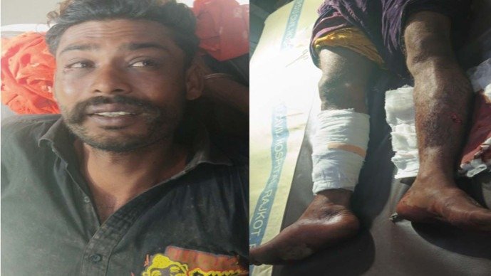 લગ્ન ક્યારે કરાવશો?, પૂછતાં જ જમાઈ પર હુમલો: સસરા-સાળાએ ધોકા-પાઇપ ફટકારી પગ ભાંગ્યા